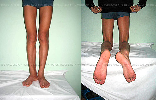 Внешние проявления наружной ротации правой ноги в сочетании с варусной деформацией (асимметрией)