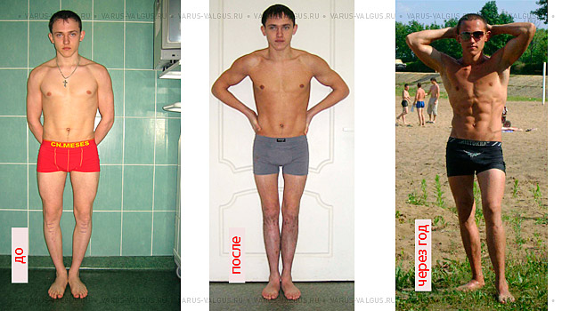 Один мужчина до, через полгода и год после комбинированной коррекции формы ног